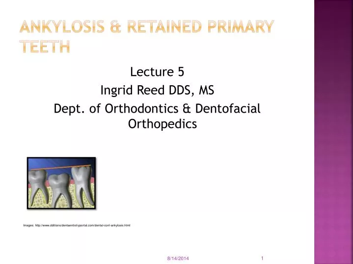ankylosis retained primary teeth
