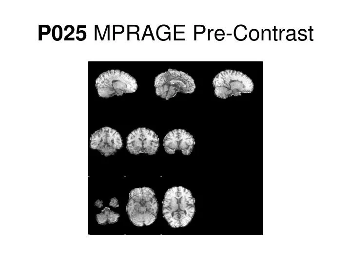 p025 mprage pre contrast