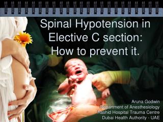 Spinal Hypotension in Elective C section: How to prevent it.