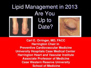 Lipid Management in 2013 Are You Up to Date?