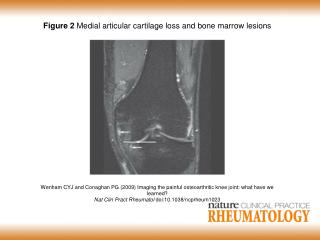 Figure 2 Medial articular cartilage loss and bone marrow lesions