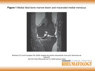 Figure 1 Medial tibial bone marrow lesion and macerated medial meniscus
