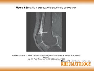 Figure 4 Synovitis in suprapatellar pouch and osteophytes