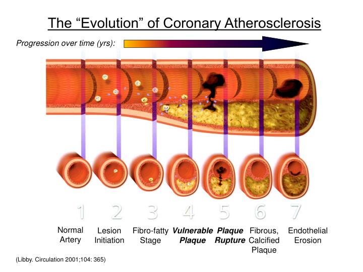 the evolution of coronary atherosclerosis