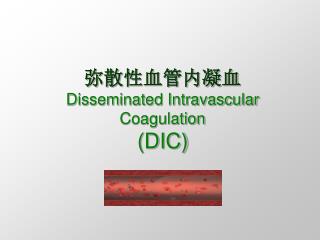 ???????? Disseminated Intravascular Coagulation (DIC)
