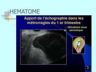hematome
