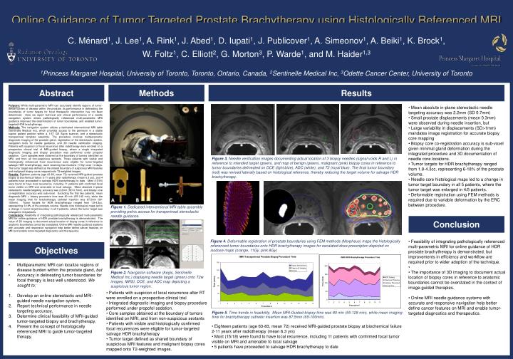 online guidance of tumor targeted prostate brachytherapy using histologically referenced mri