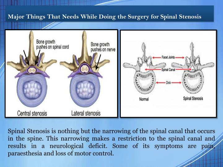major things that needs while doing the surgery for spinal stenosis