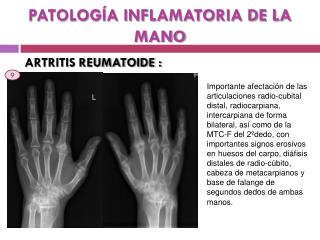patolog a inflamatoria de la mano