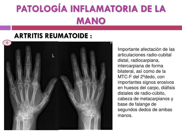 patolog a inflamatoria de la mano