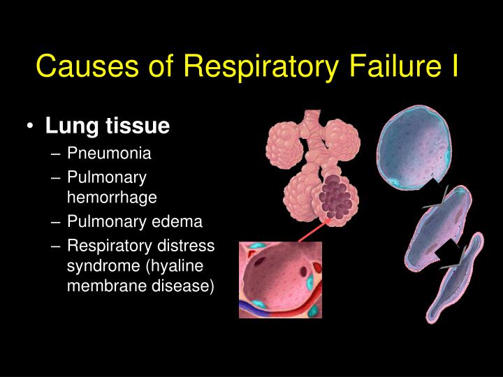 causes of respiratory failure i