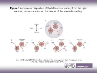 Lim, J. C. E. et al. (2011) Anomalous origination of a coronary artery from the opposite sinus