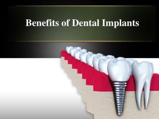 Dental Implants in Houston - A Permanent Solution for Missin