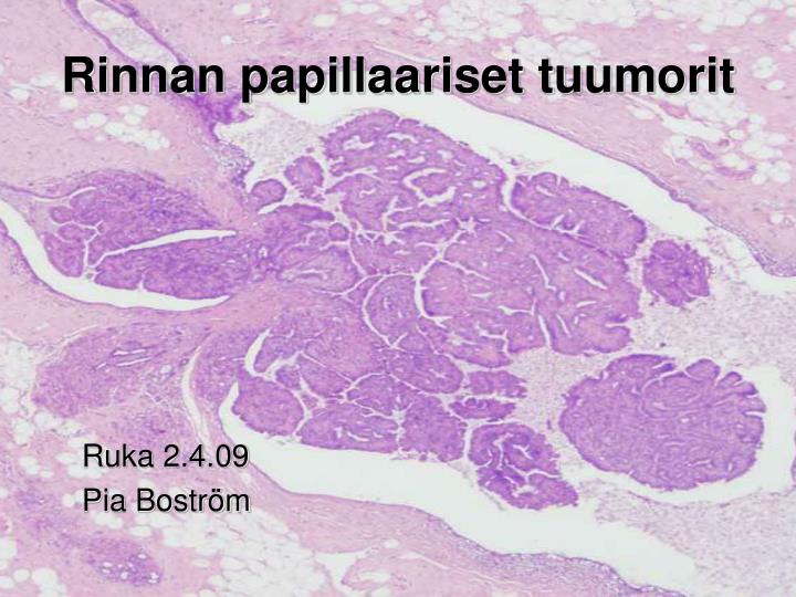 rinnan papillaariset tuumorit