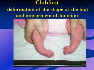 Clubfoot deformation of the shape of the foot and impairment of function