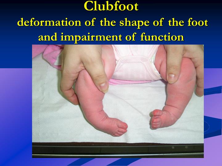 clubfoot deformation of the shape of the foot and impairment of function