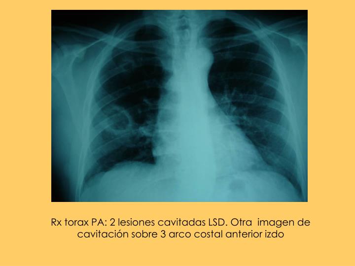 rx torax pa 2 lesiones cavitadas lsd otra imagen de cavitaci n sobre 3 arco costal anterior izdo