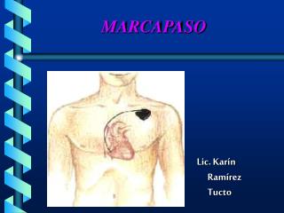 marcapaso
