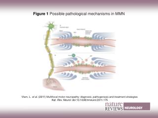 Figure 1 Possible pathological mechanisms in MMN