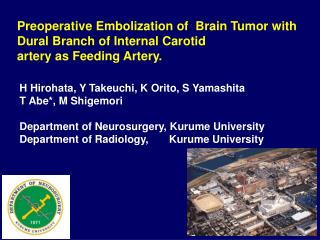 Preoperative Embolization of Brain Tumor with Dural Branch of Internal Carotid