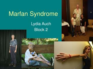 Marfan Syndrome