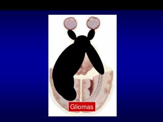 Gliomas