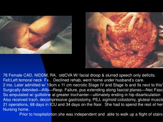 76 Female CAD, NIDDM, RA, oldCVA W/ facial droop &amp; slurred speech only deficits.