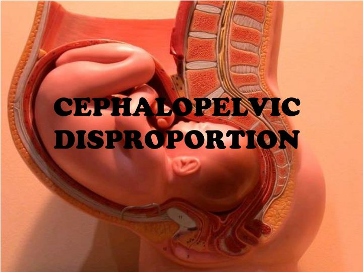 cephalopelvic disproportion