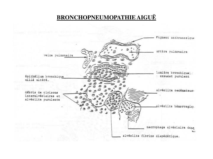 bronchopneumopathie aigu