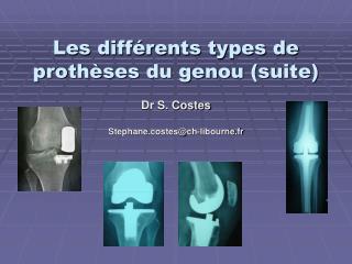 les diff rents types de proth ses du genou suite