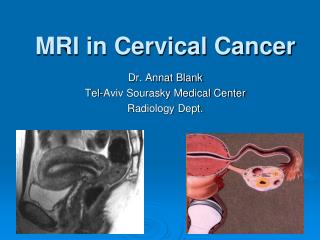 MRI in Cervical Cancer