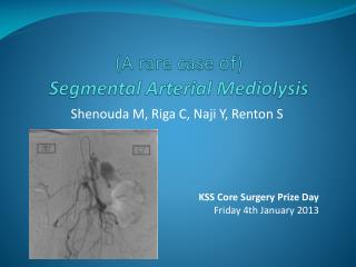 (A rare case of) Segmental A r terial Mediolysis