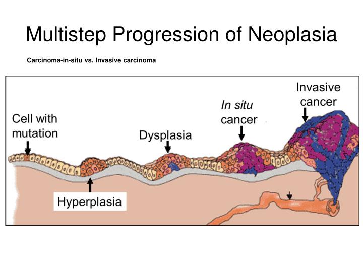 multistep progression of neoplasia