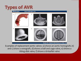 Types of AVR