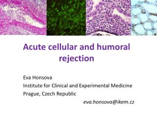 Acute cellular and humoral rejection