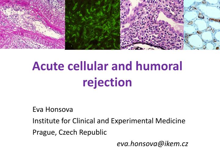 acute cellular and humoral rejection