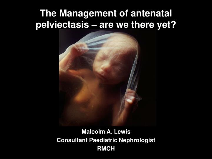 the management of antenatal pelviectasis are we there yet