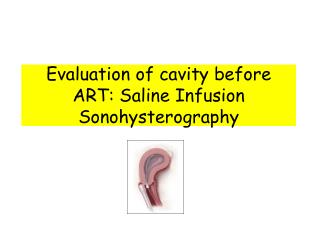 Evaluation of cavity before ART: Saline Infusion Sonohysterography