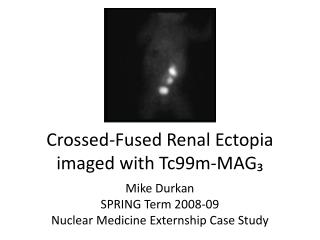 Crossed-Fused Renal Ectopia imaged with Tc99m-MAG₃