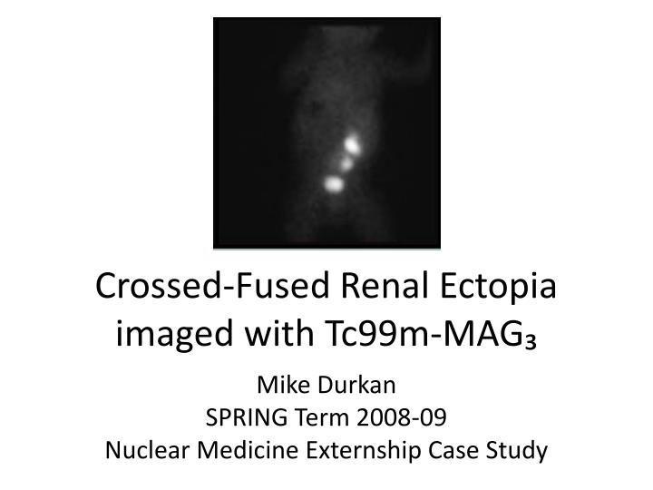 crossed fused renal ectopia imaged with tc99m mag