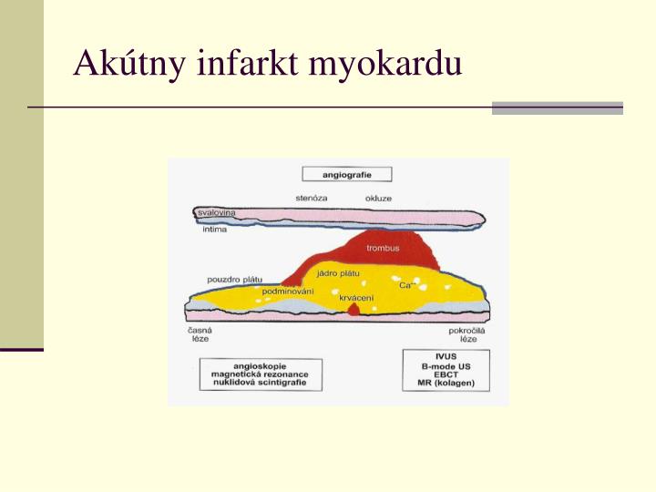 ak tny infarkt myokardu