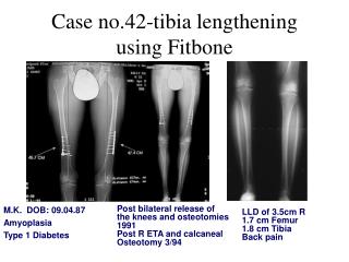Case no.42-tibia lengthening using Fitbone