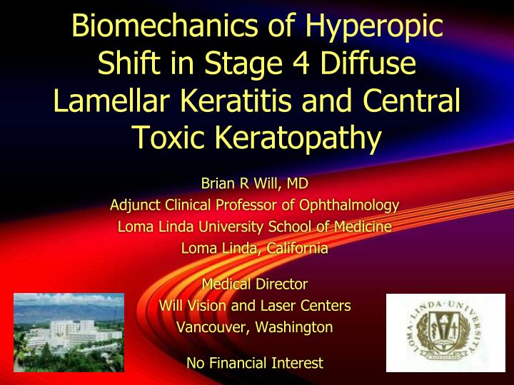 biomechanics of hyperopic shift in stage 4 diffuse lamellar keratitis and central toxic keratopathy