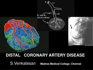 DISTAL CORONARY ARTERY DISEASE S.Venkatesan Madras Medical College. Chennai