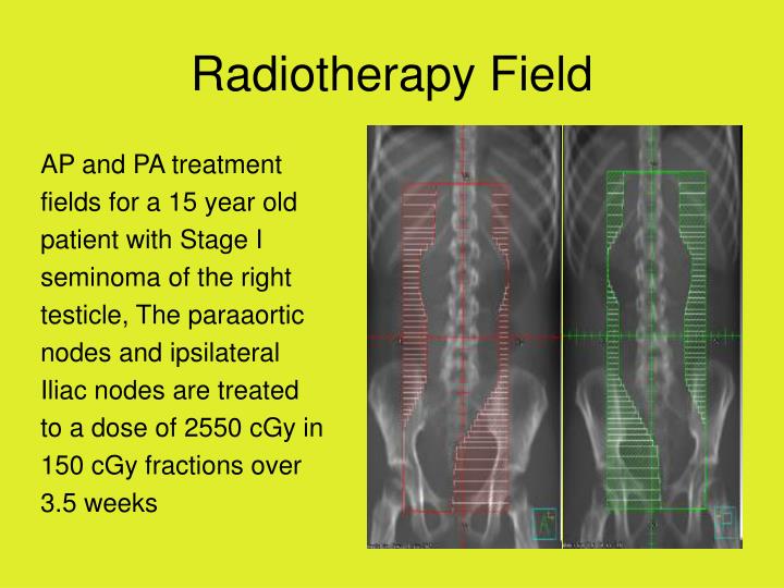radiotherapy field