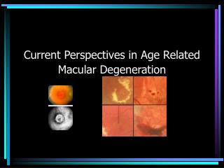 Current Perspectives in Age Related Macular Degeneration