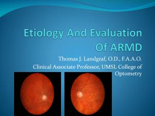 Etiology And Evaluation Of ARMD