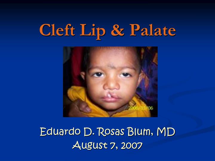cleft lip palate