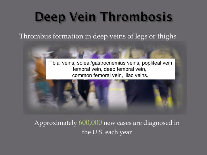 deep vein thrombosis