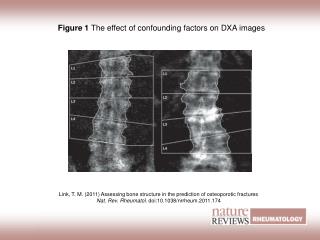 Figure 1 The effect of confounding factors on DXA images